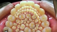 Hyperdontie