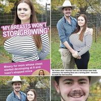 Cauchemar pour cette femme car sa poitrine n’arrête pas de grandir depuis ses 8 ans . 