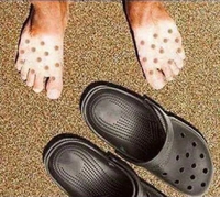 Quand tu as trop porté tes crocs au soleil