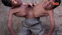 Des jumeaux siamois indiens qui ne veulent pas être séparés