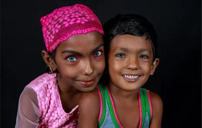 Au Bangladesh, Mehedi et Tasnim possèdent une pigmentation inhabituelle due à une carence de mélanine dans l'iris de leurs yeux, leur donnant une couleur bleu-lagon. (Photo de Sultan Ahmed Niloy)