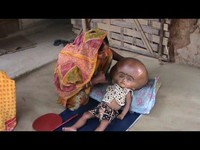 Un Indien espère un "miracle" pour sa fille hydrocéphale
