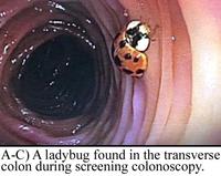 Coccinelle dans le colon