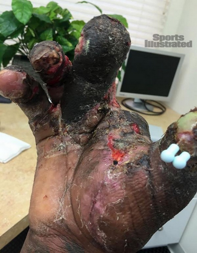 Photo de la main de Jason Pierre-Paul, joueur NFL, après un accident avec un feu d'artifice lors de la fête nationale.