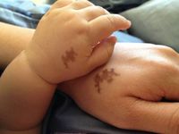 Tache de naissance