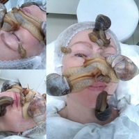 Escargothérapie